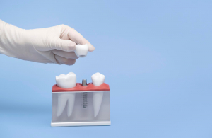 Tutte le possibilit&agrave; di riavere i denti fissi: i diversi tipi di trattamento
