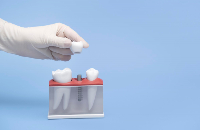 Tutte le possibilit&agrave; di riavere i denti fissi: i diversi tipi di trattamento