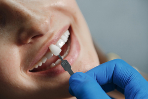 Niente pi&ugrave; denti storti, scheggiati o spezzati e: una possibile soluzione sono le faccette dentali