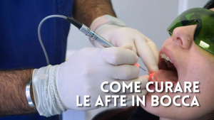 Afte della bocca: perch&eacute; vengono, quanto durano e quando preoccuparsi davvero