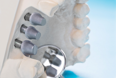 Impianti dentali: masticazione efficiente e qualit&agrave; della vita