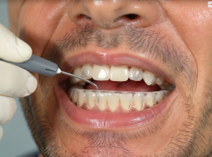 Injection Technique: la rivoluzione dell'odontoiatria estetica americana